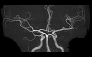 頭部血管 MRアンギオ画像