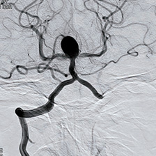 脳血管撮影画像（動脈瘤）