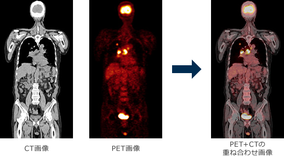 PET＋CTの重ね合わせ画像