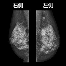 マンモグラフィ画像