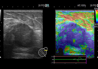 乳腺エコー画像